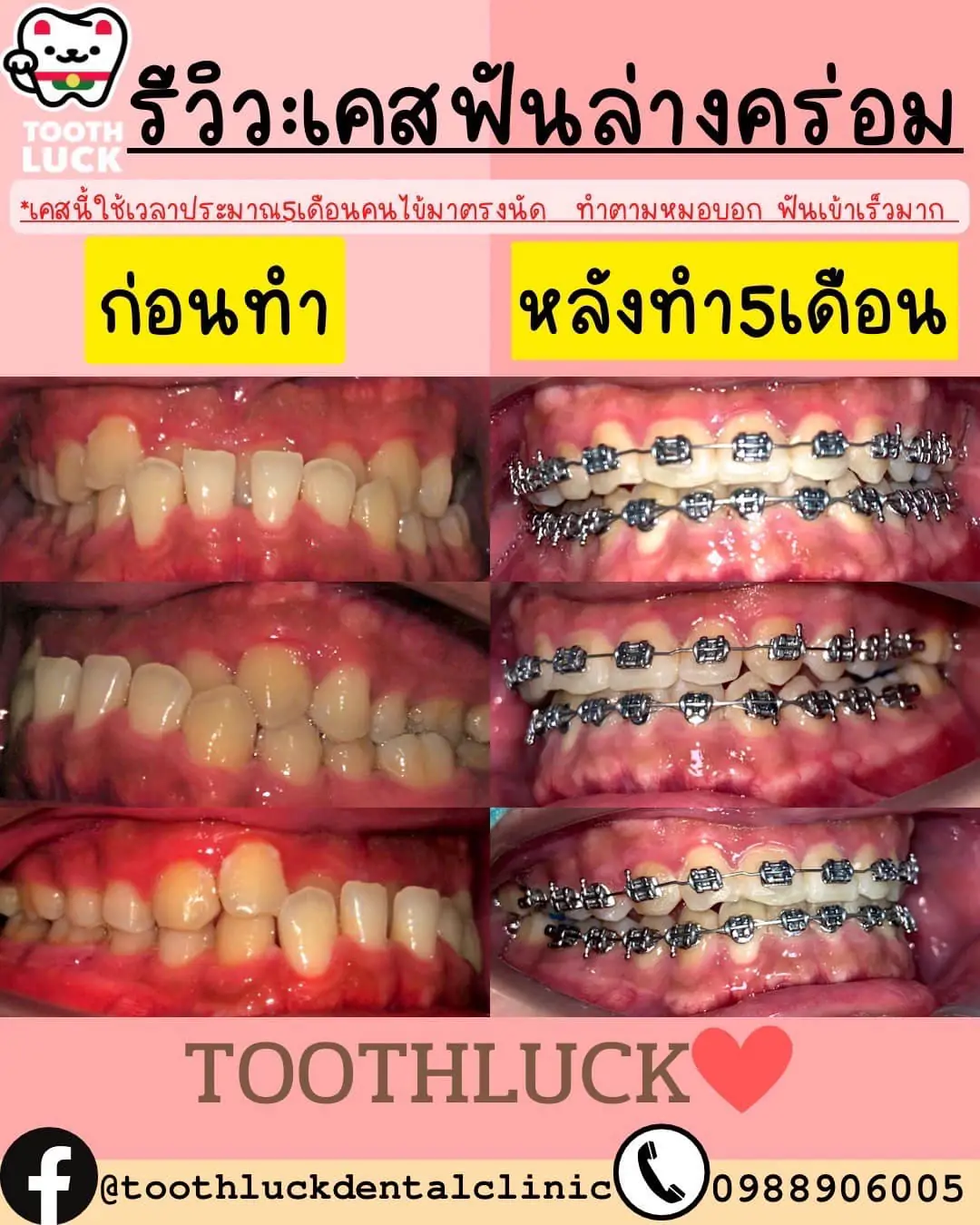 จัดฟัน Tooth Luck dental clinic - ทำฟัน จัดฟัน ขอนแก่น