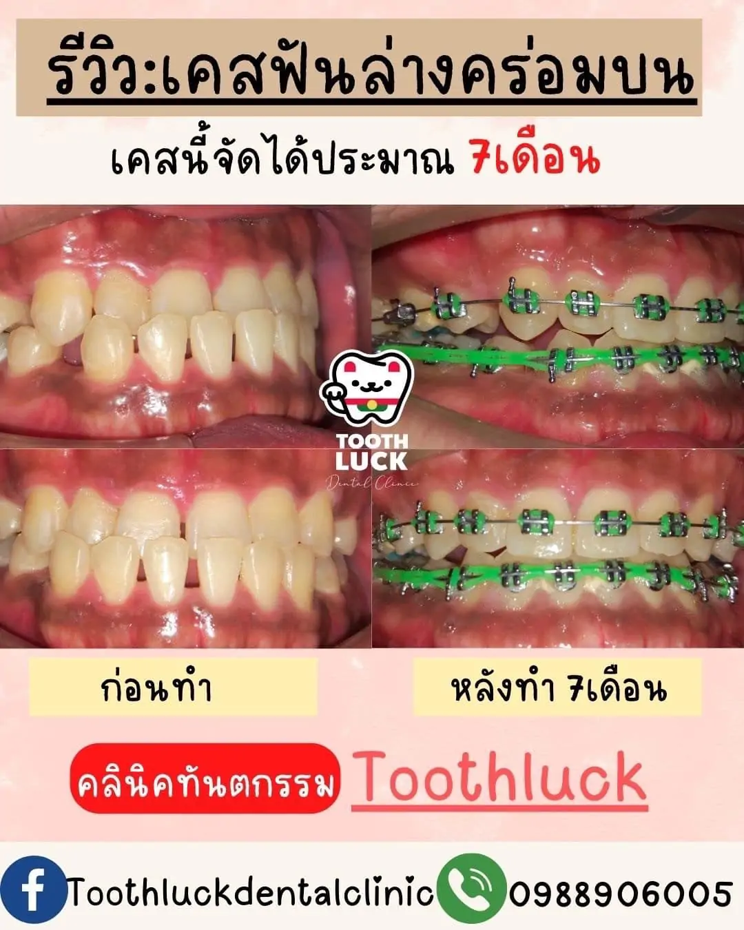 จัดฟัน Tooth Luck dental clinic - ทำฟัน จัดฟัน ขอนแก่น