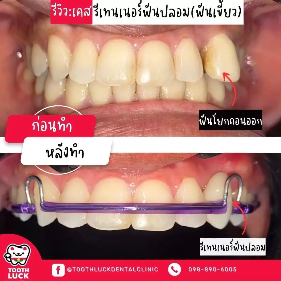 ฟันปลอม