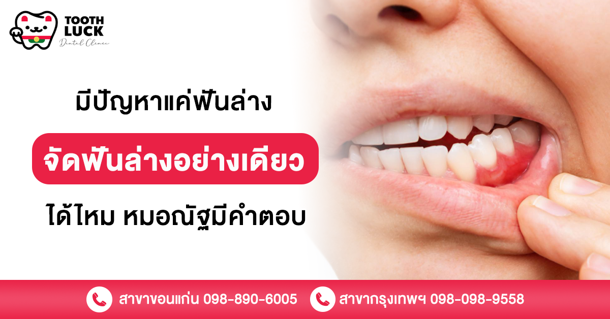 จัดฟันล่างอย่างเดียว