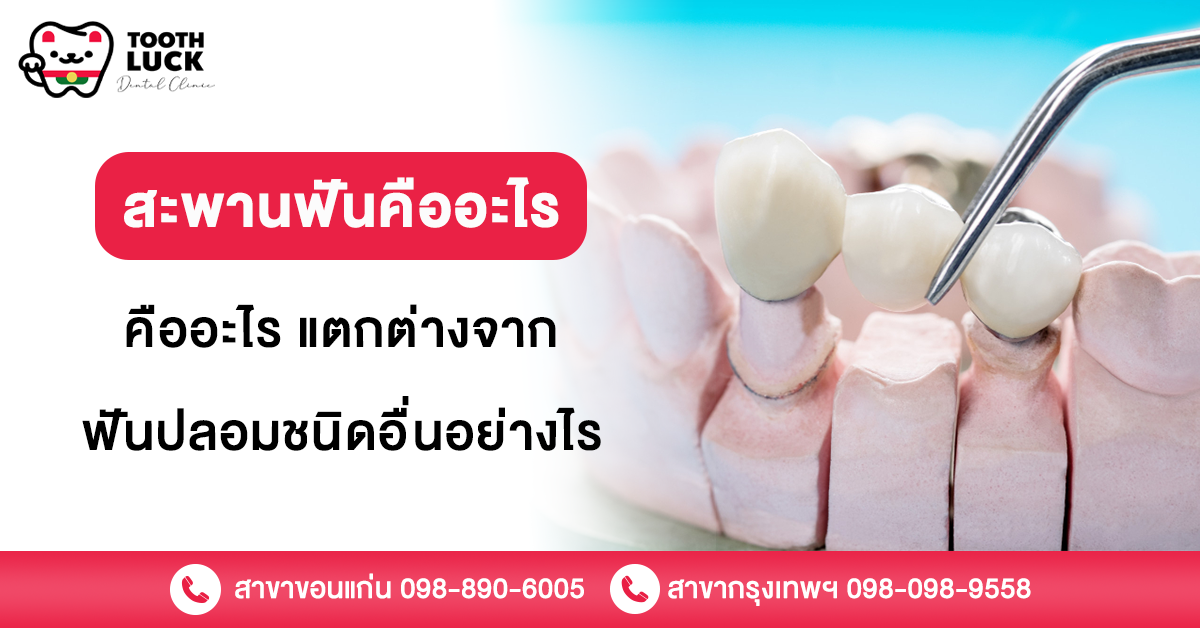สะพานฟัน