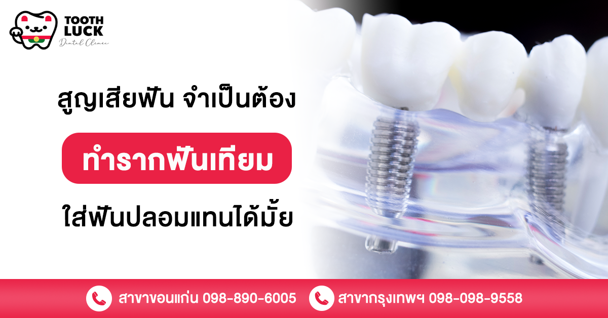 สูญเสียฟัน