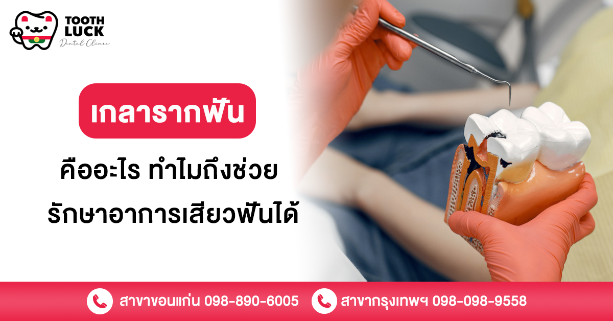 เกลารากฟัน