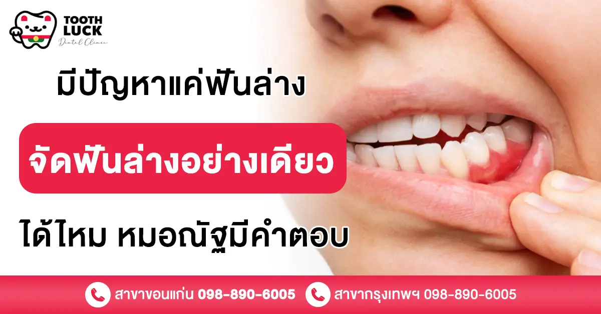 จัดฟันล่างอย่างเดียว