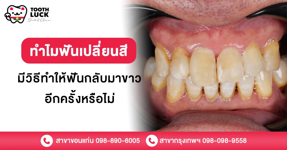 ฟันเปลี่ยนสี