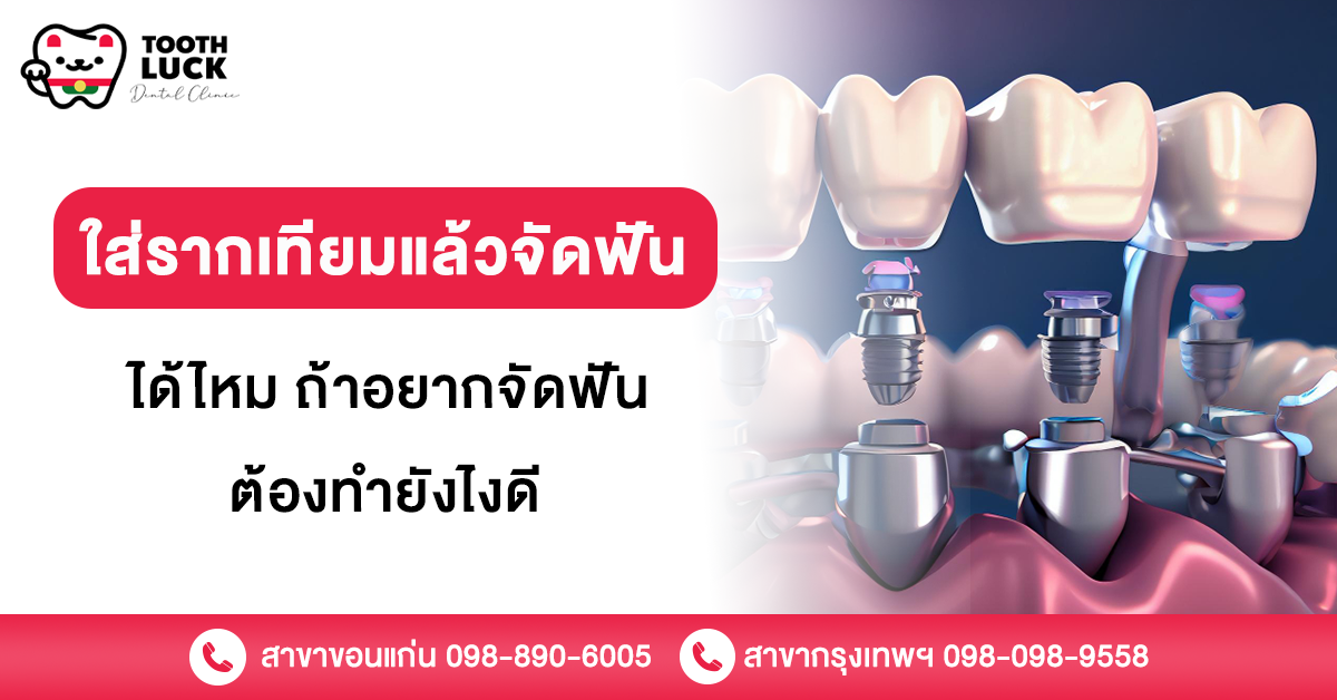 ใส่รากเทียม