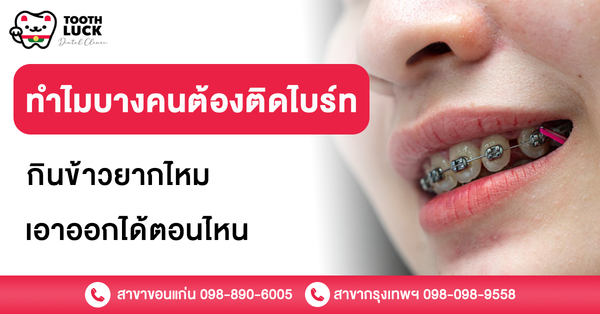 ติดไบร์ท