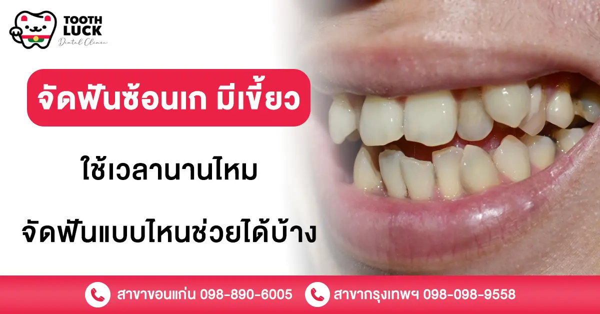 จัดฟันซ้อนเก มีเขี้ยว