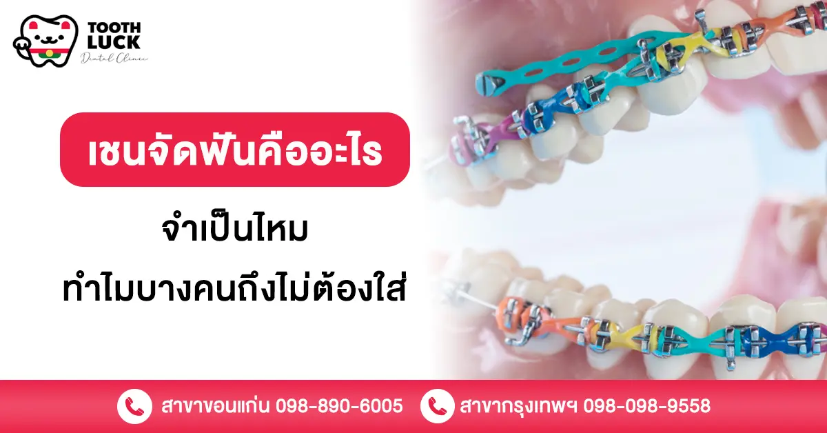 เชนจัดฟัน