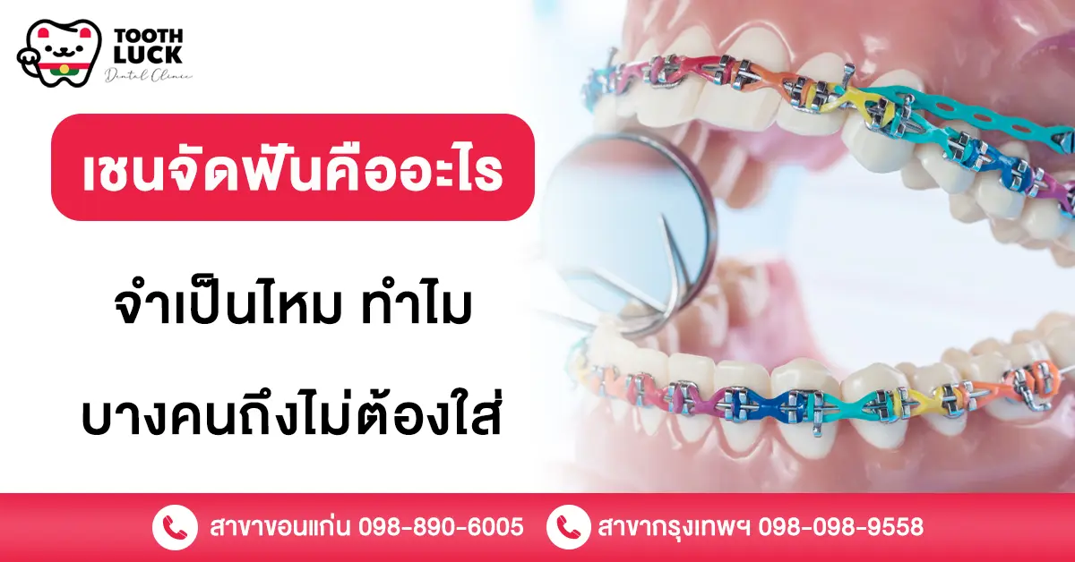 เชนจัดฟัน