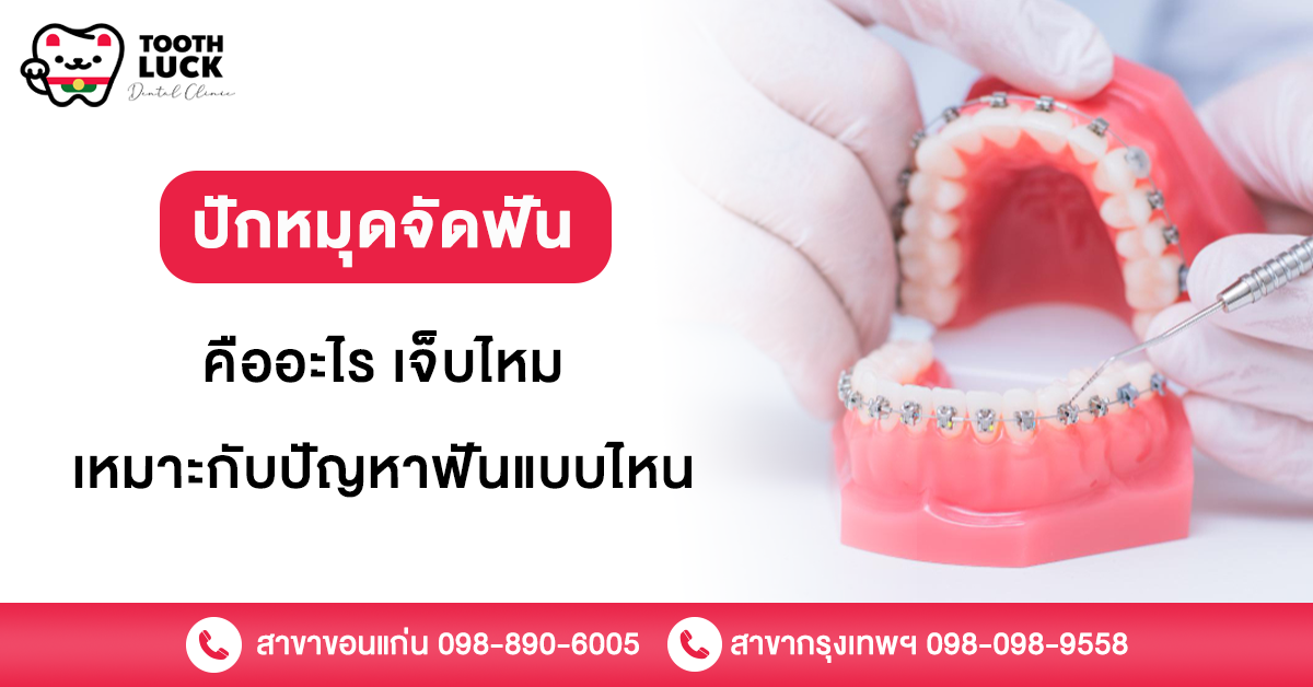 หมุดจัดฟัน