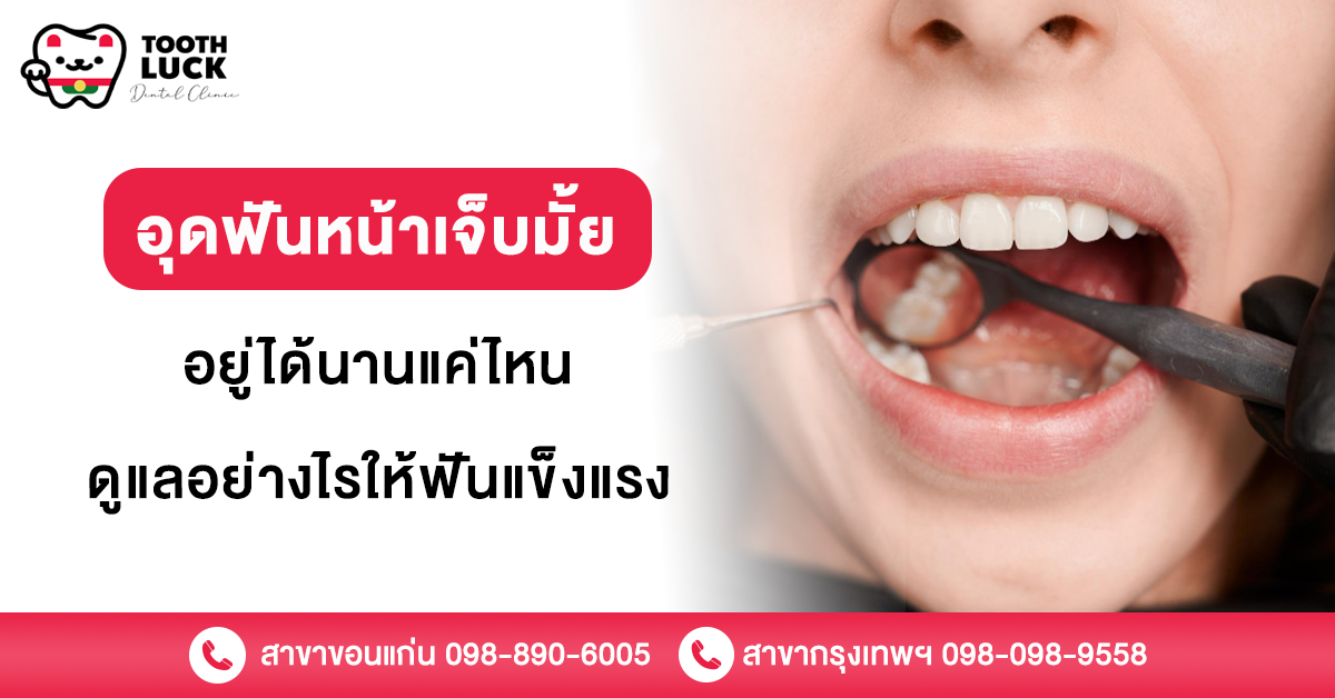 อุดฟันหน้า