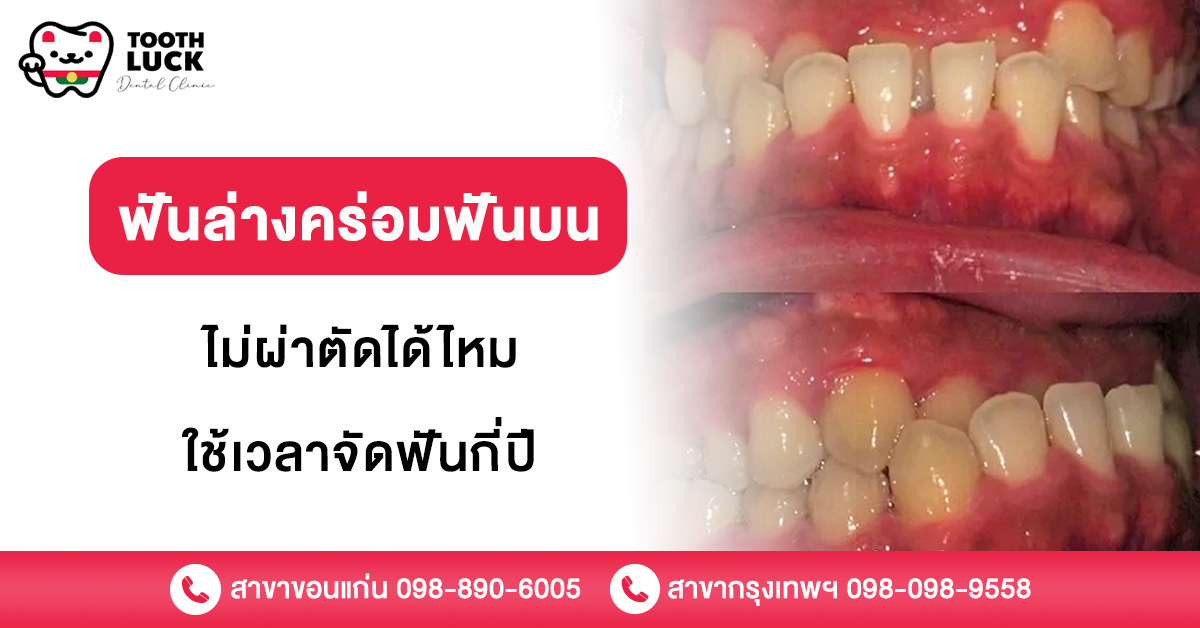 ฟันล่างคร่อมฟันบน