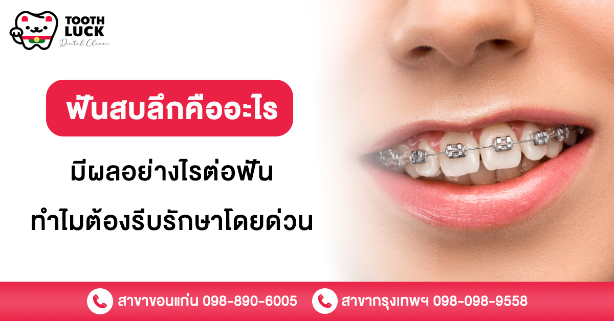 ฟันสบลึก