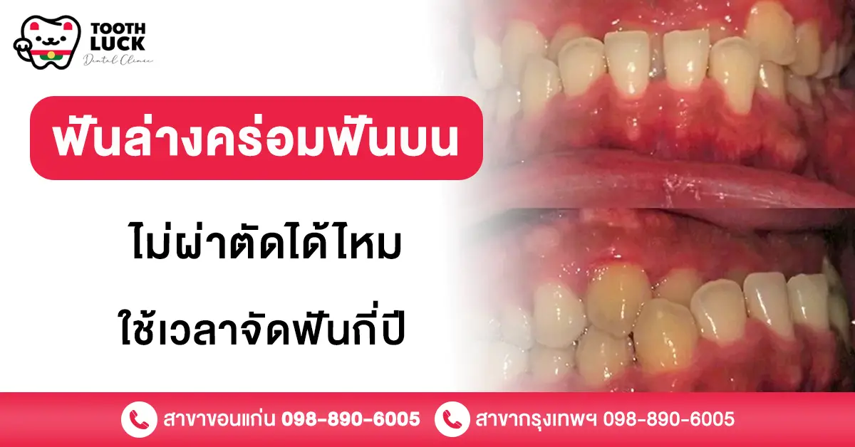 ฟันล่างคร่อมฟันบน