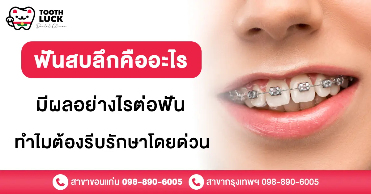 ฟันสบลึก