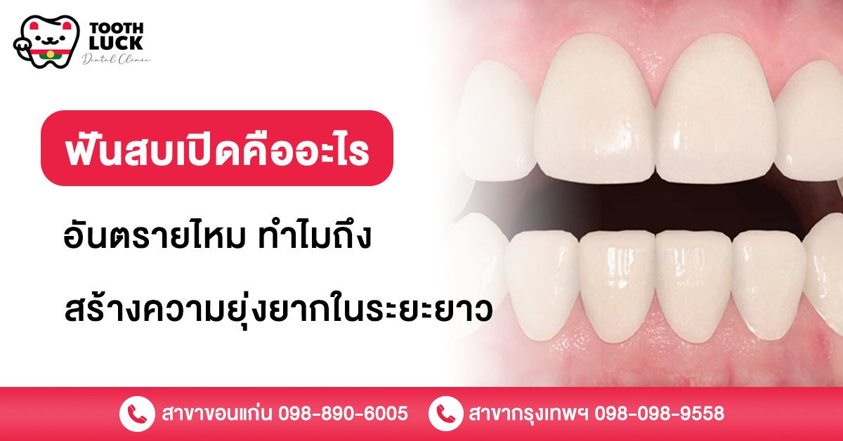 ฟันสบเปิด