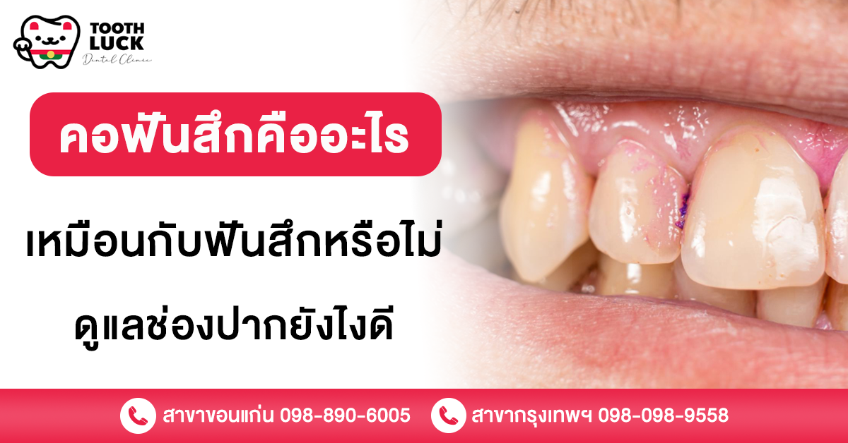 คอฟันสึก