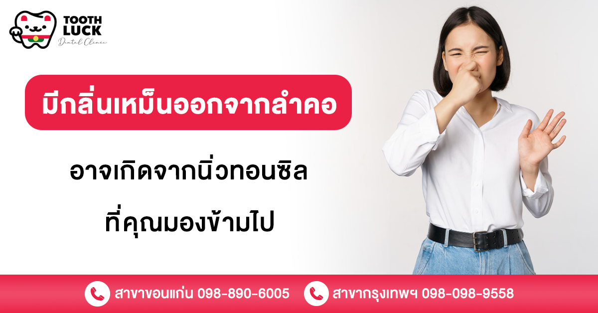นิ่วทอนซิล