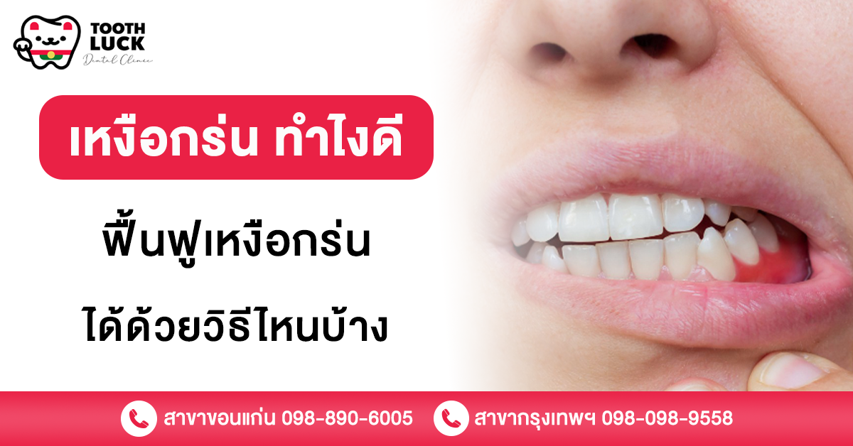เหงือกร่น