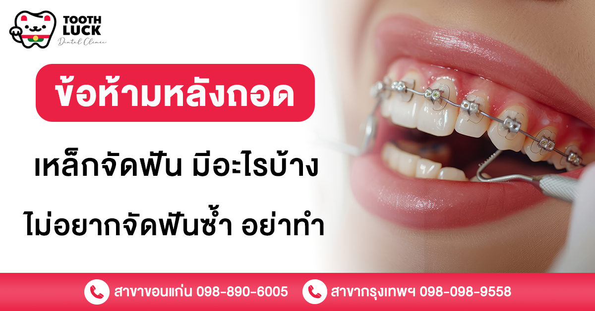 ข้อห้ามหลังถอดเหล็กจัดฟัน