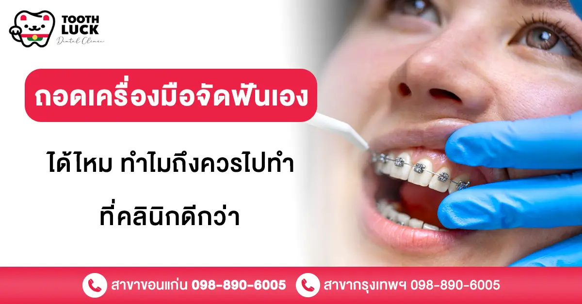 ถอดเครื่องมือจัดฟัน