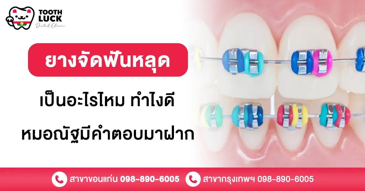 ยางจัดฟันหลุด