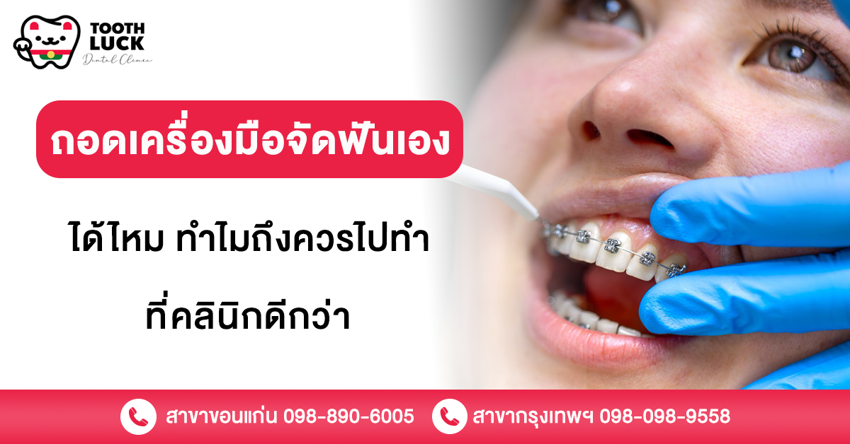 ถอดเครื่องมือจัดฟันเองได้ไหม ทำไมถึงควรไปทำที่คลินิกดีกว่า