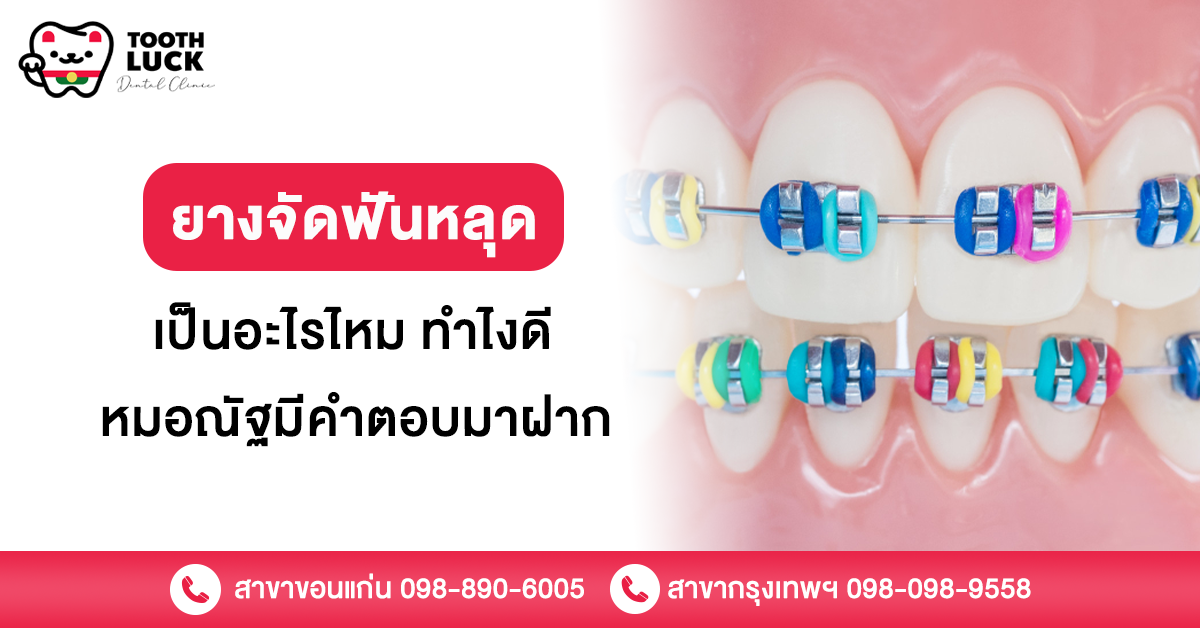 ยางจัดฟันหลุด เป็นอะไรไหม ทำไงดี หมอณัฐมีคำตอบมาฝาก