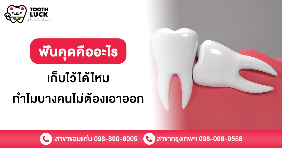 ฟันคุด