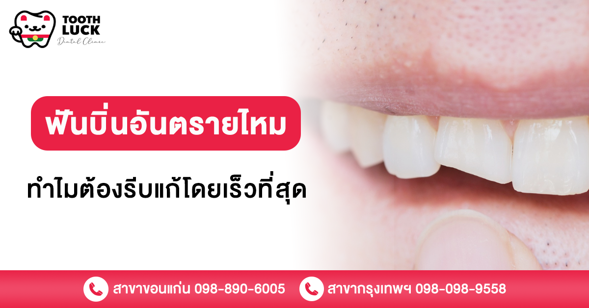 ฟันบิ่น