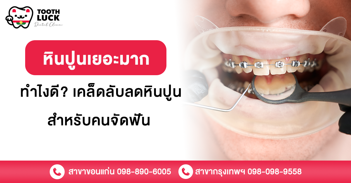 หินปูนเยอะมาก ทําไงดี? เคล็ดลับลดหินปูนสำหรับคนจัดฟัน