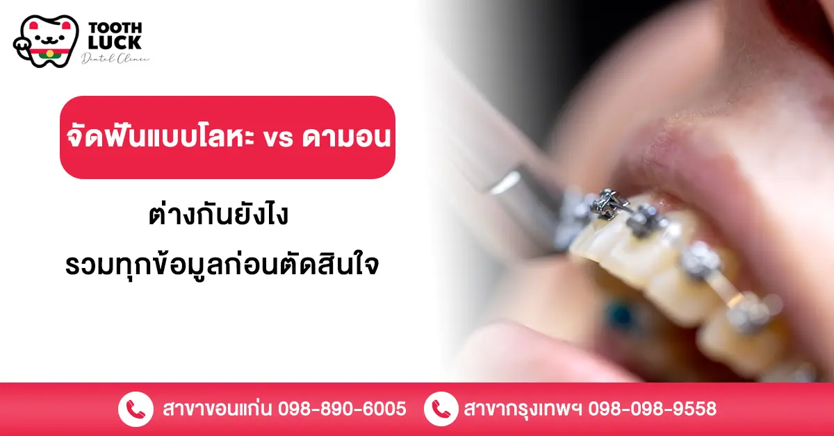 จัดฟันแบบโลหะ vs ดามอน ต่างกันยังไง รวมทุกข้อมูลก่อนตัดสินใจ