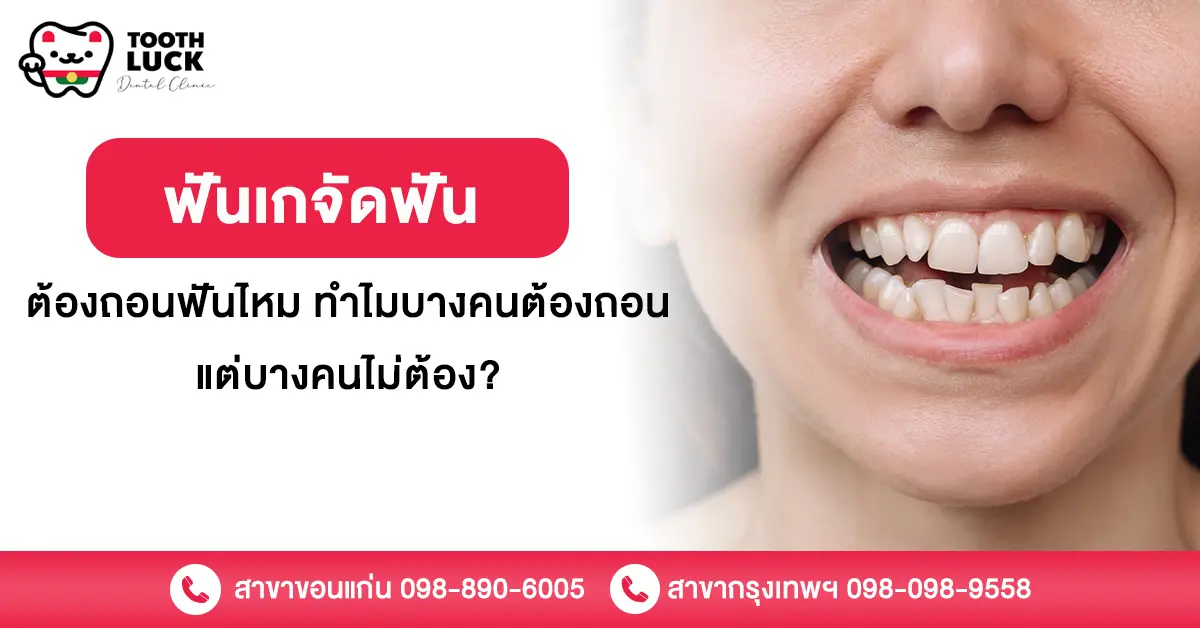ฟันเก จัดฟัน ต้องถอนฟันไหม ทำไมบางคนต้องถอนแต่บางคนไม่ต้อง?