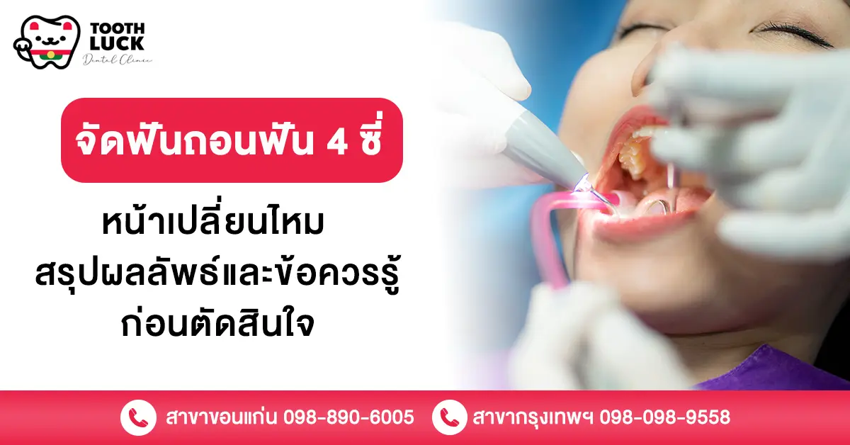 จัดฟันถอนฟัน 4 ซี่ หน้าเปลี่ยนไหม สรุปผลลัพธ์และข้อควรรู้ก่อนตัดสินใจ