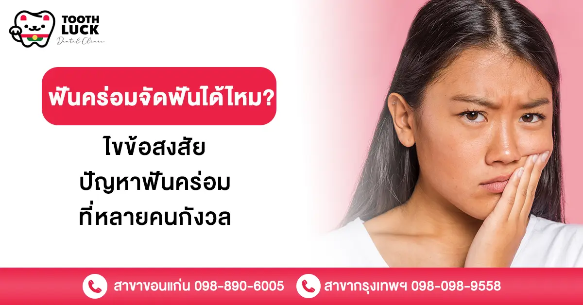 ฟันคร่อมจัดฟันได้ไหม ? ไขข้อสงสัยปัญหาฟันคร่อมที่หลายคนกังวล