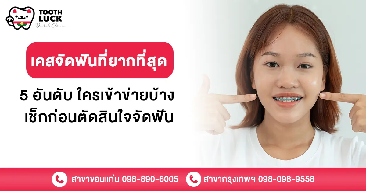 จัดฟันที่ยากที่สุด 5 อันดับ ใครเข้าข่ายบ้าง เช็กก่อนตัดสินใจจัดฟัน