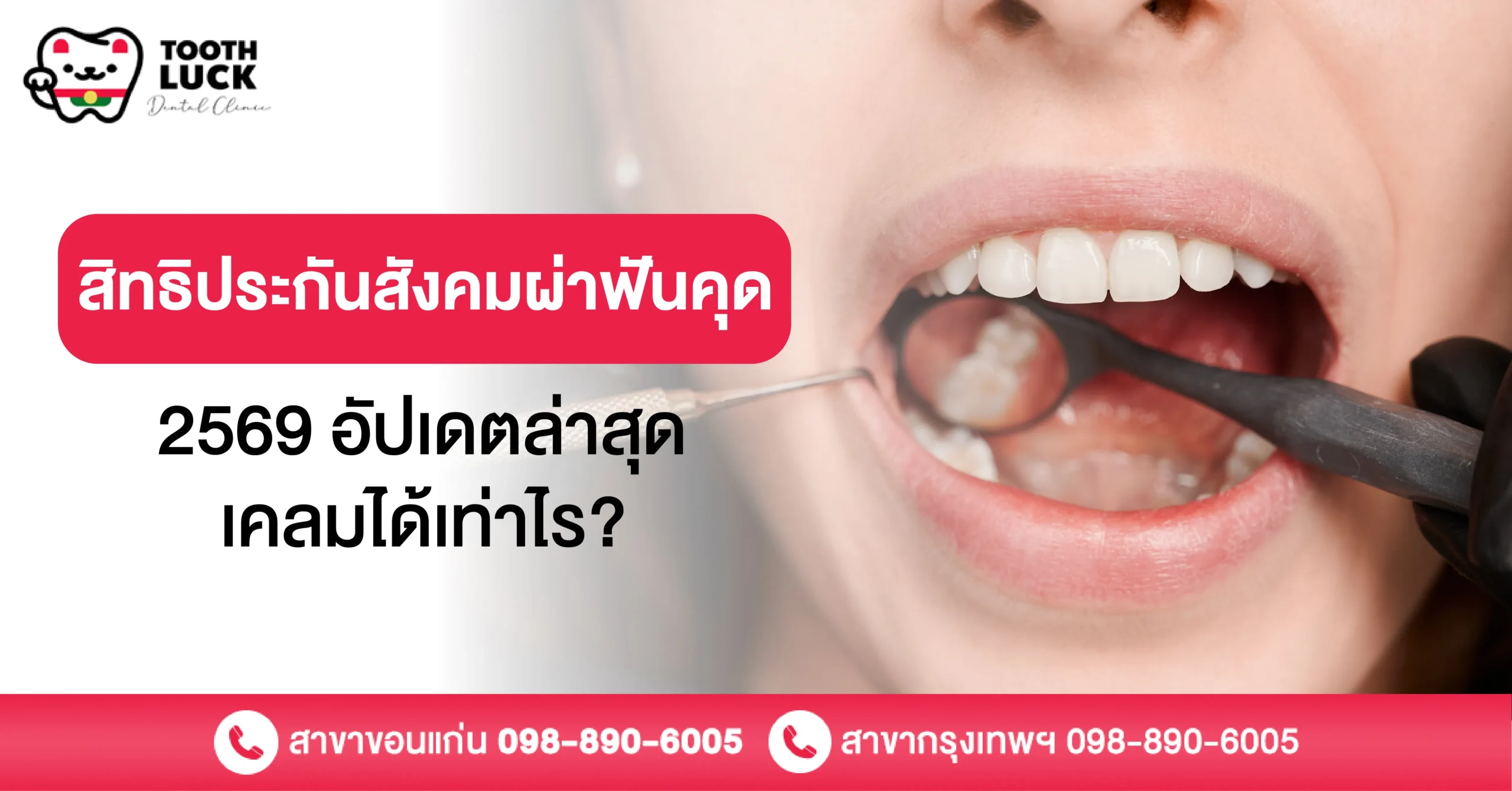 สิทธิประกันสังคมผ่าฟันคุด 2569 อัปเดตล่าสุด เคลมได้เท่าไร?