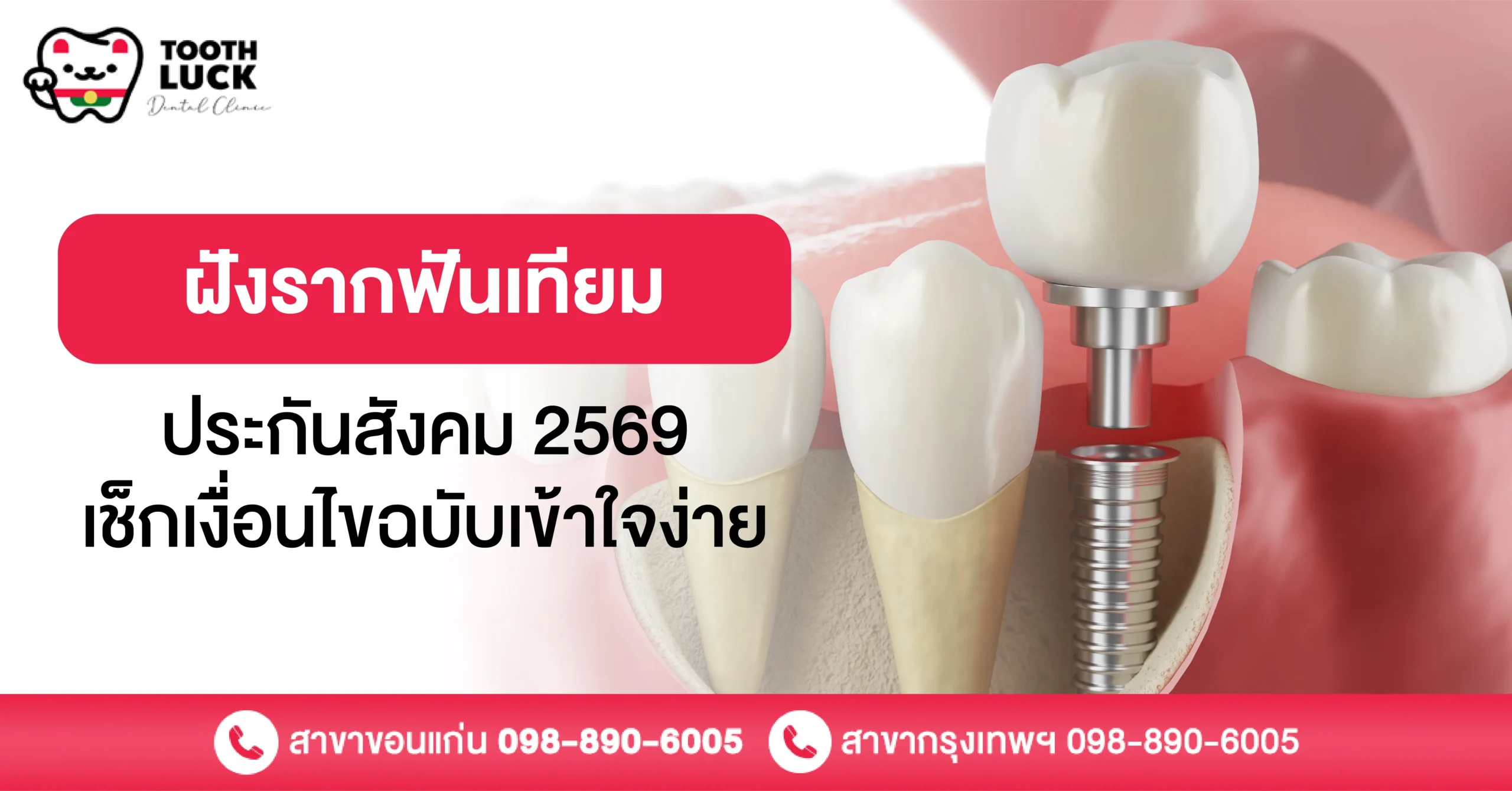 ฝังรากฟันเทียมประกันสังคม 2569 เช็กเงื่อนไขฉบับเข้าใจง่าย
