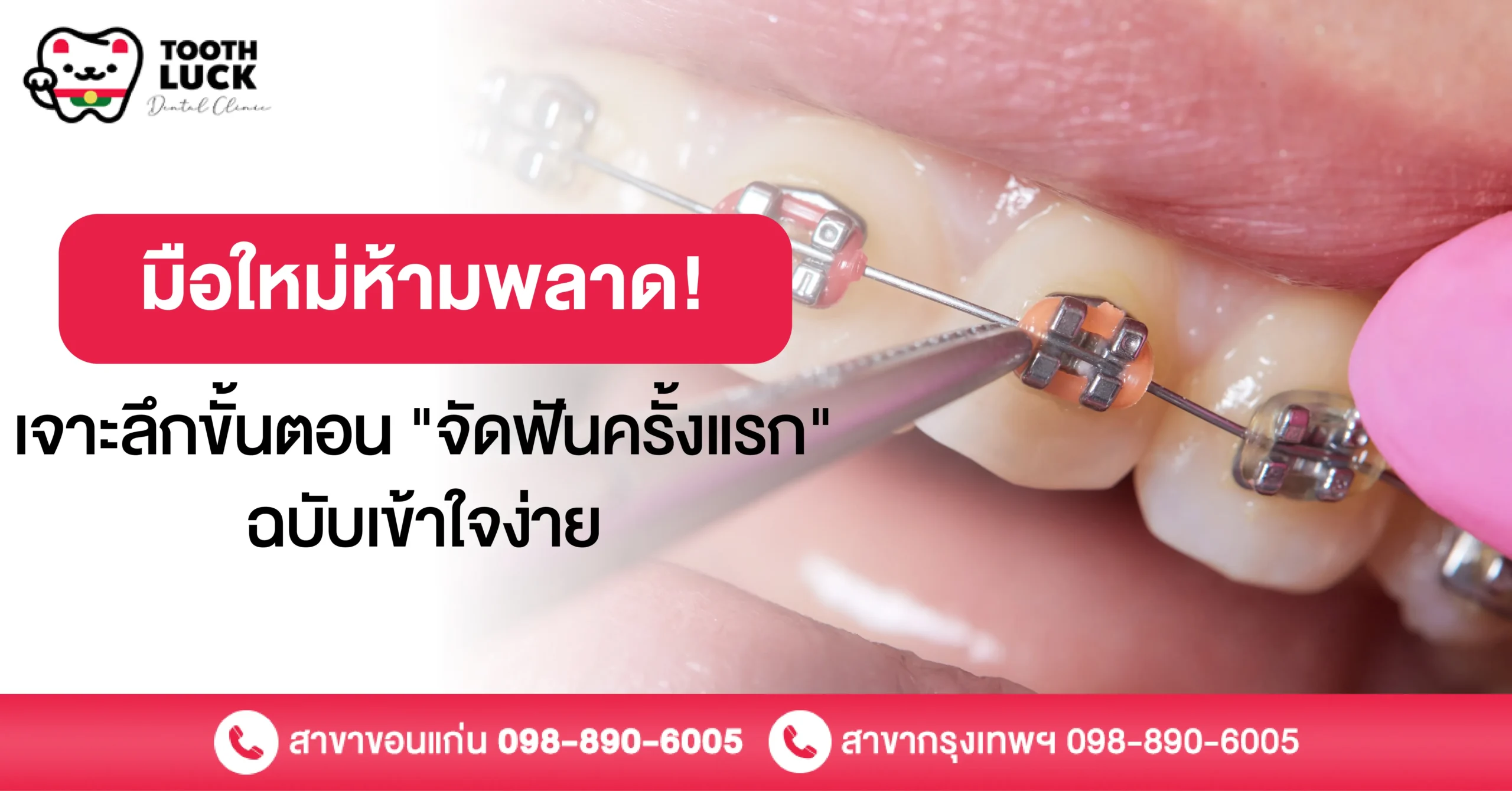 มือใหม่ห้ามพลาด! เจาะลึกขั้นตอน "จัดฟันครั้งแรก" ฉบับเข้าใจง่าย
