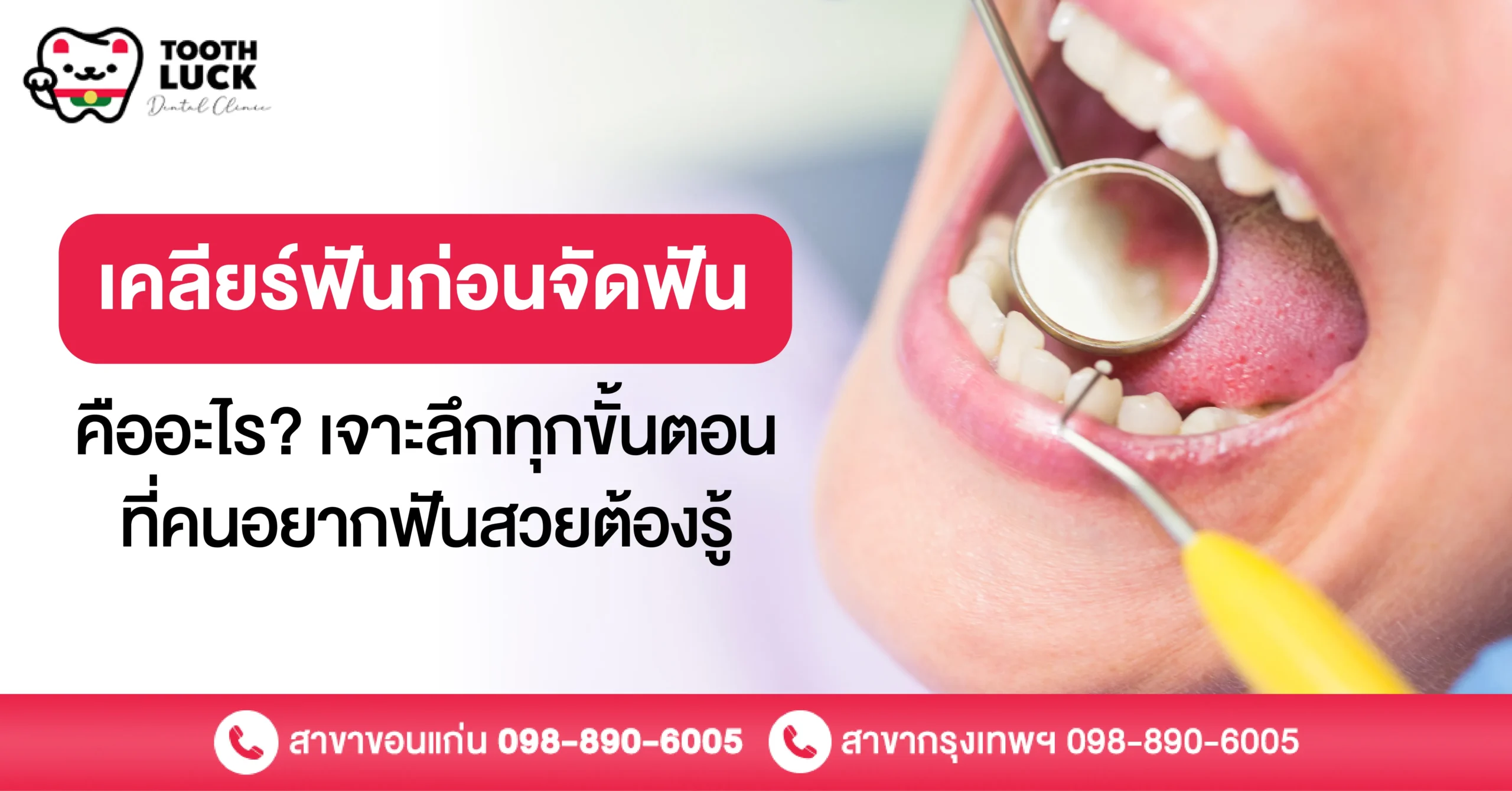 เคลียร์ฟันก่อนจัดฟัน คืออะไร? เจาะลึกทุกขั้นตอนที่คนอยากฟันสวยต้องรู้