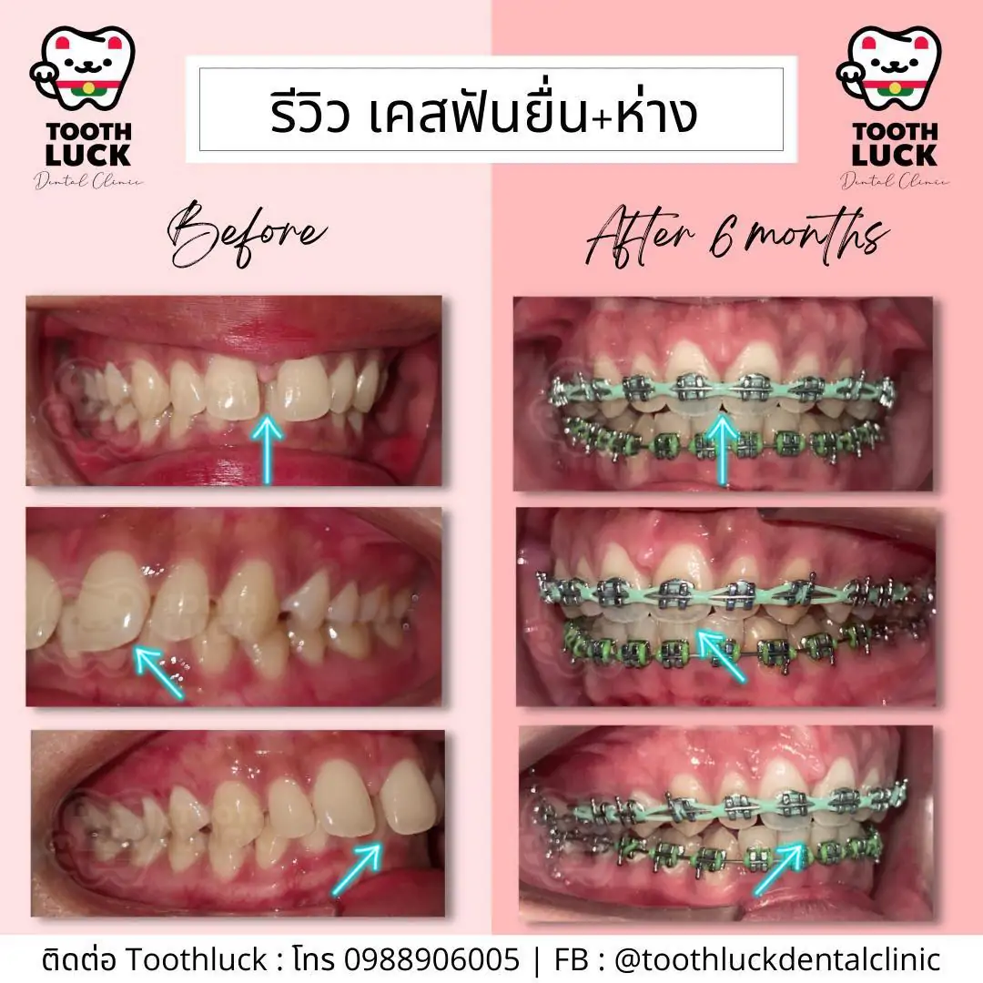 จัดฟัน Tooth Luck dental clinic - ทำฟัน จัดฟัน ขอนแก่น