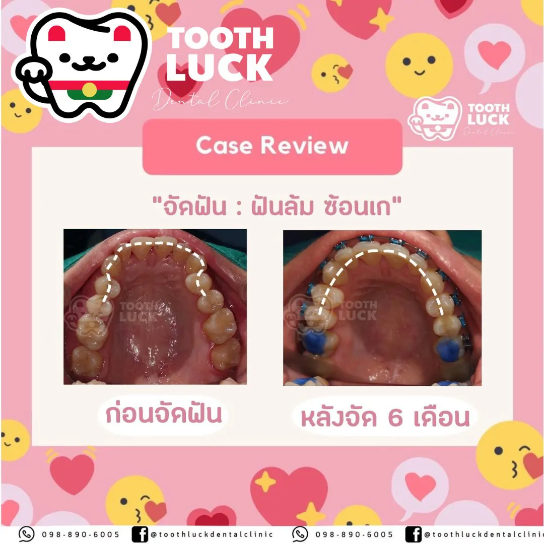 จัดฟัน Tooth Luck dental clinic - ทำฟัน จัดฟัน ขอนแก่น