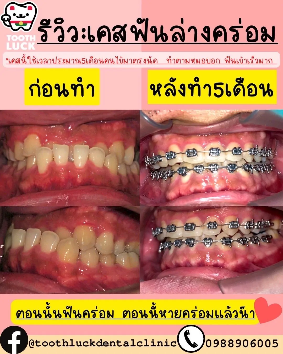 จัดฟัน Tooth Luck dental clinic - ทำฟัน จัดฟัน ขอนแก่น