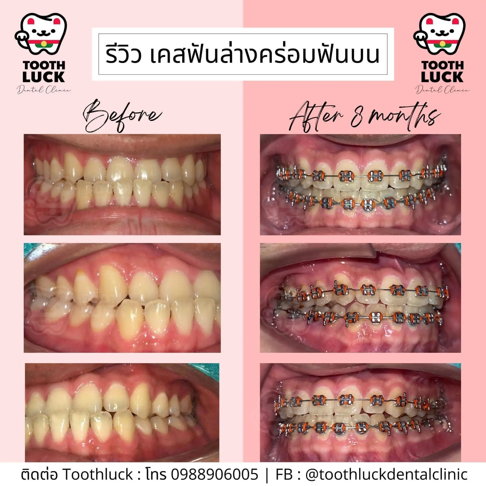 จัดฟัน Tooth Luck dental clinic - ทำฟัน จัดฟัน ขอนแก่น