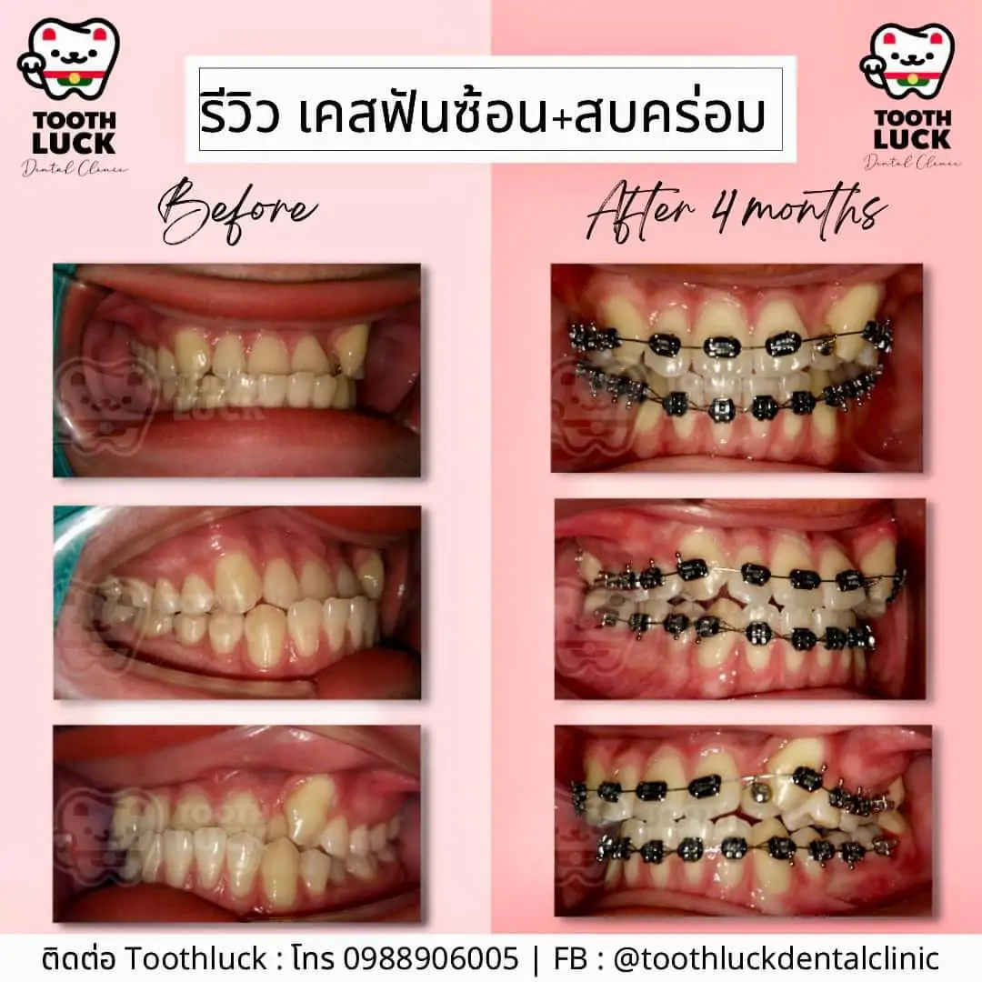 จัดฟัน Tooth Luck dental clinic - ทำฟัน จัดฟัน ขอนแก่น