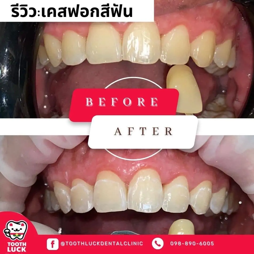 ฟอกสีฟัน