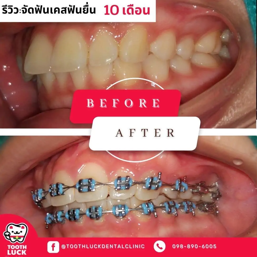 Tooth Luck dental clinic - ทำฟัน จัดฟัน ขอนแก่น