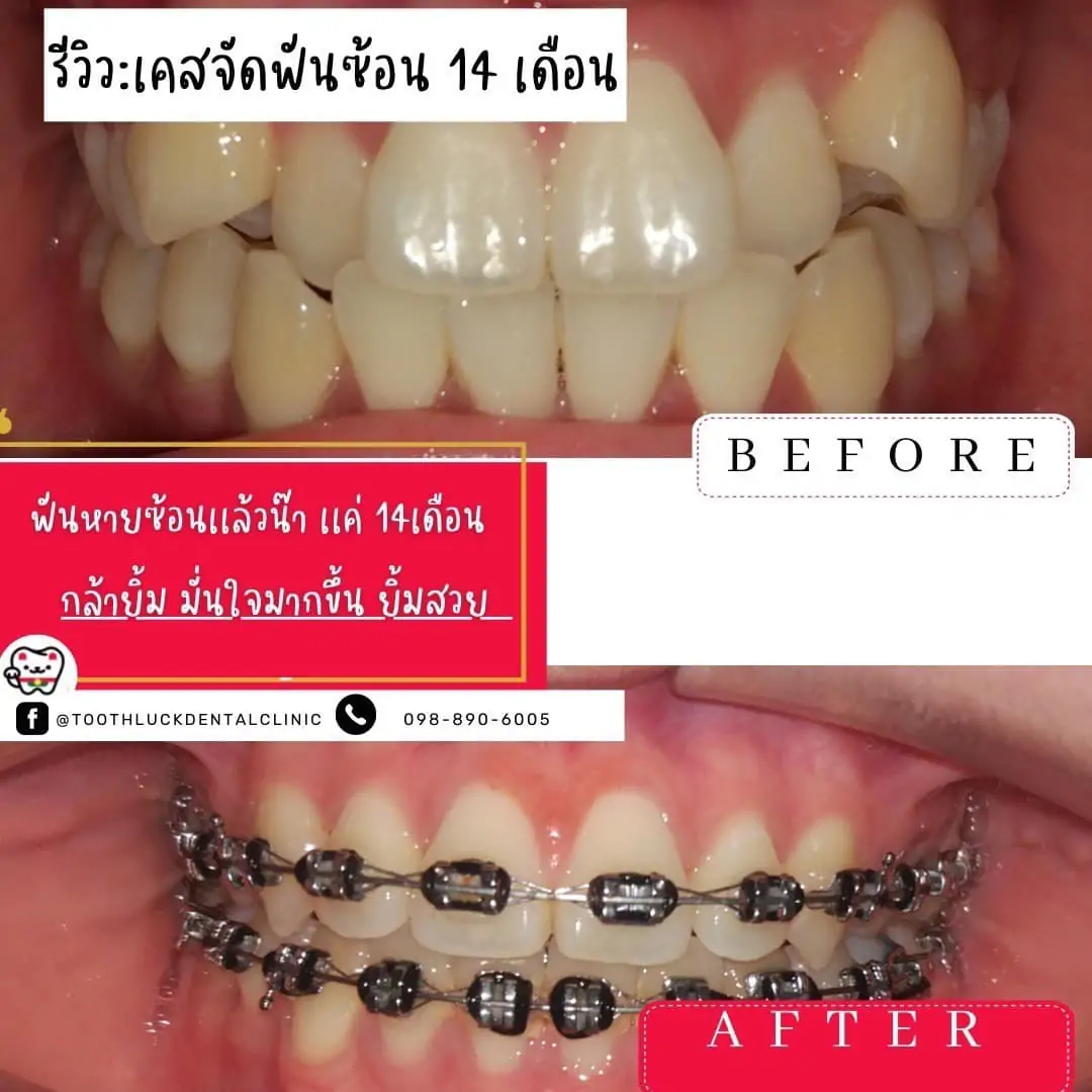 Tooth Luck dental clinic - ทำฟัน จัดฟัน ขอนแก่น