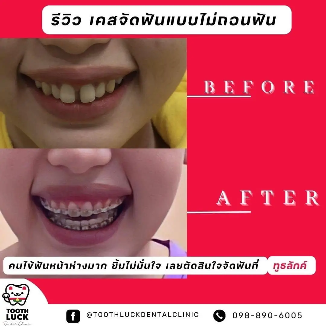 Tooth Luck dental clinic - ทำฟัน จัดฟัน ขอนแก่น